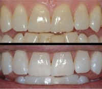Express white - відбілювання зубів та встановлення зубних прикрас (СКАЙСИ)
